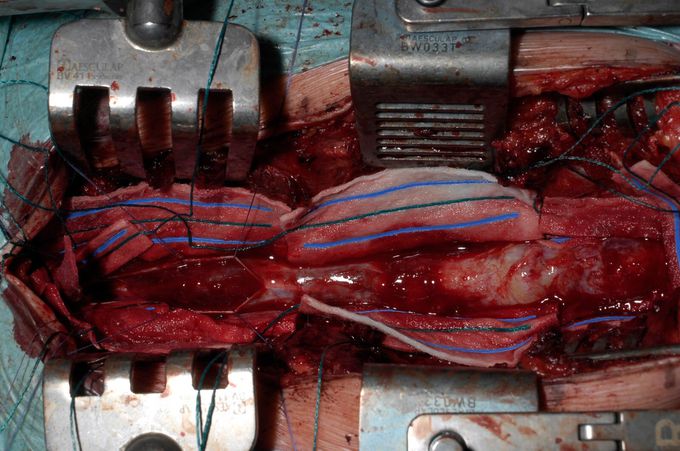 Myxopapillary Ependymoma