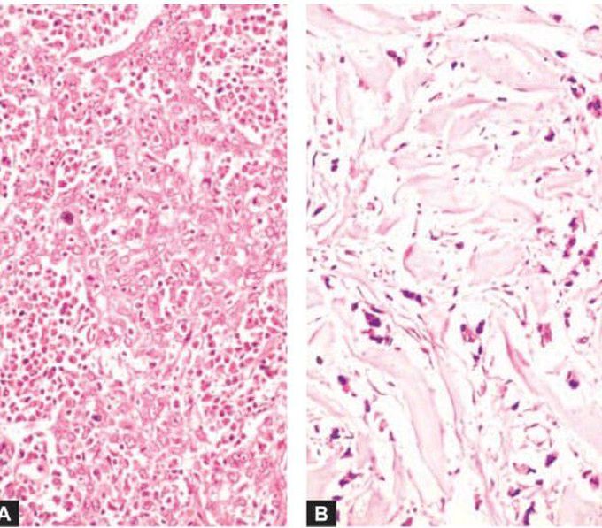 Tumour stroma