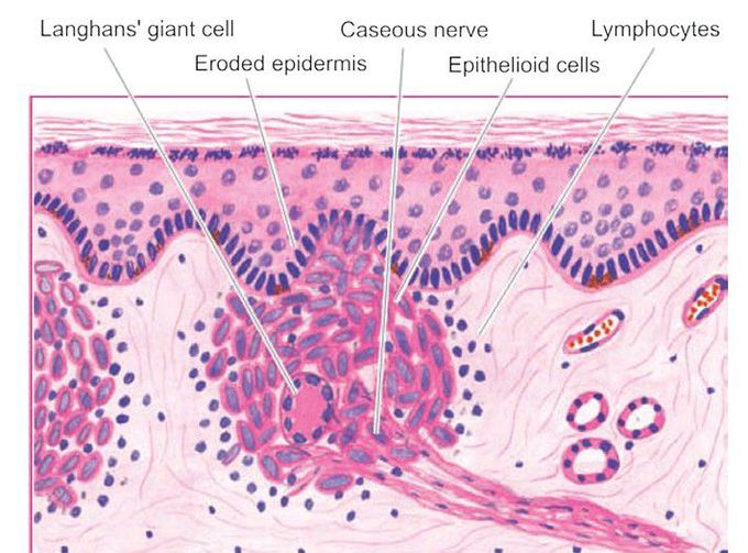 Tuberculoid leprosy (TT).