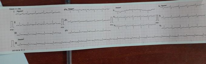 Gravida 2 para1 pt 24 wk gestation