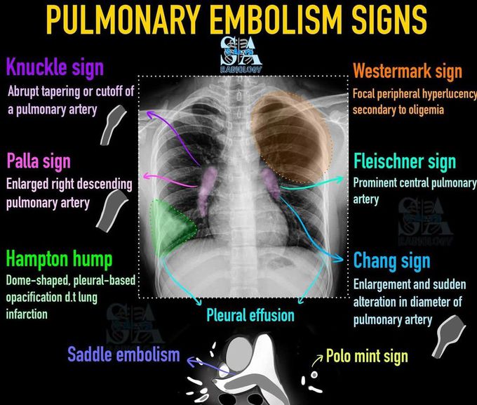 Pulmonary Embolism Signs