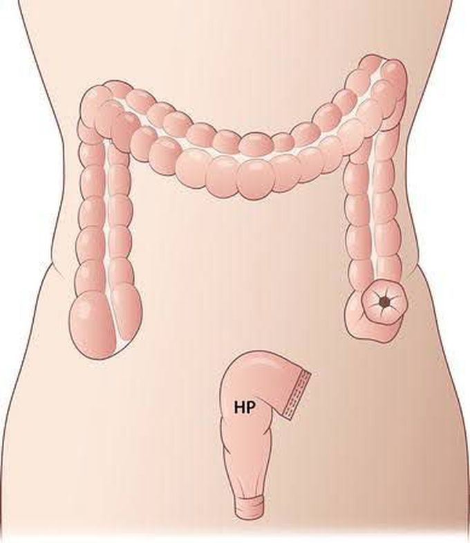 Hartman's procedure