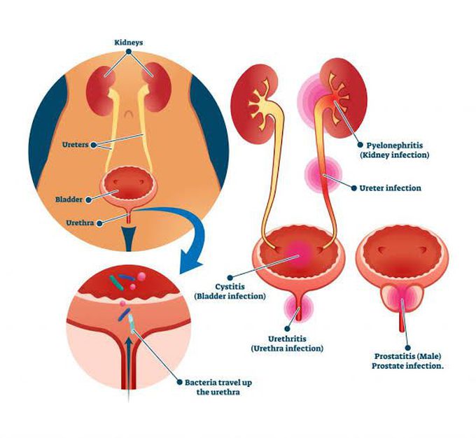 Urinary tract infection