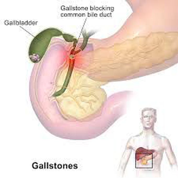 Cholelithiasis symptoms