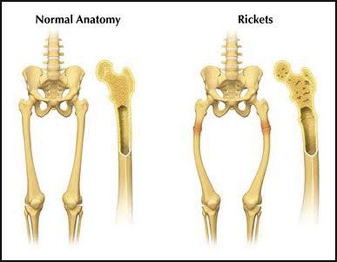 Rickets