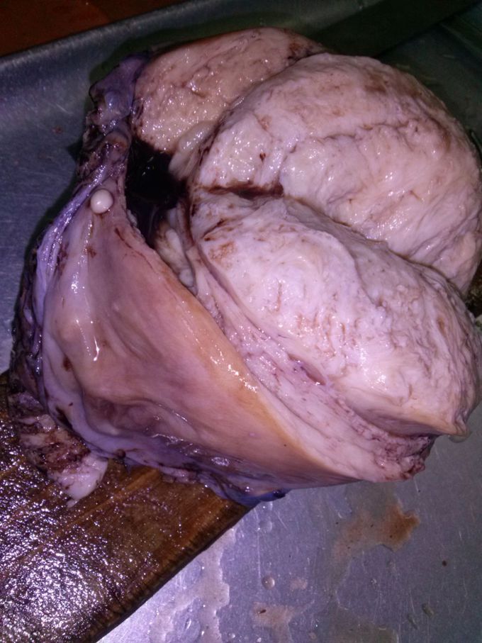ovarian dermoid cyst 😷