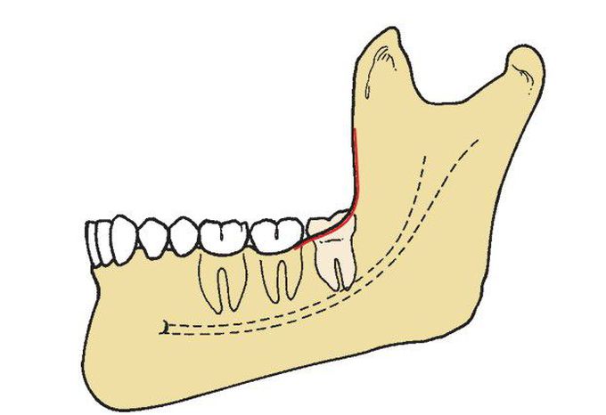 Pell and Gregory class A impaction.