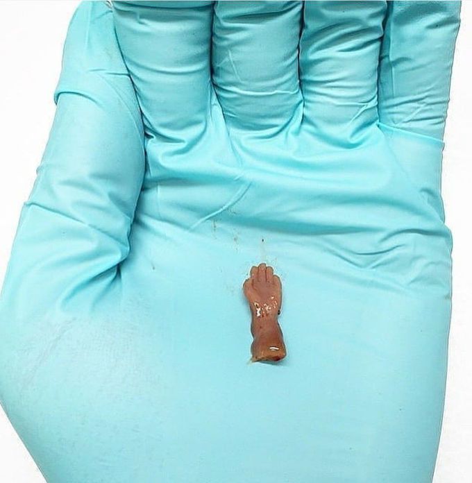 Hand of fetus