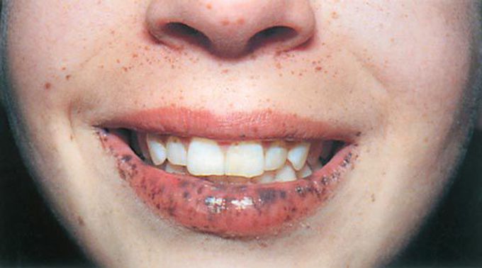 Peutz-Jeghers syndrome