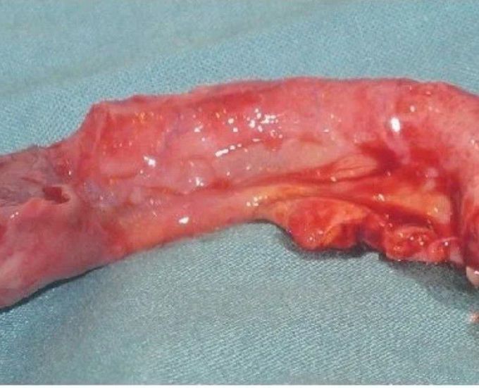 Inflamed appendix in a girl treated for missed appendicitis after self-induced abortion,Figure - available via license: CC BY 2.0
