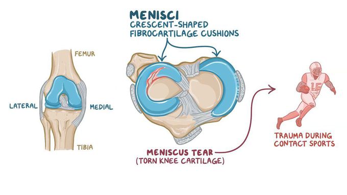 Meniscus Tear Symptoms