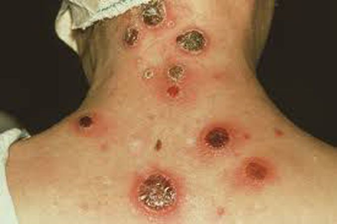 Syphilis