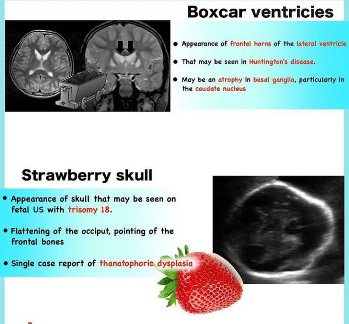 Boxcar Ventricles and Strawberry Skull
