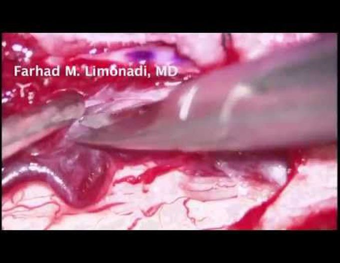 Removal of spinal cord tumor (meningioma): Spine Tumor Surgery