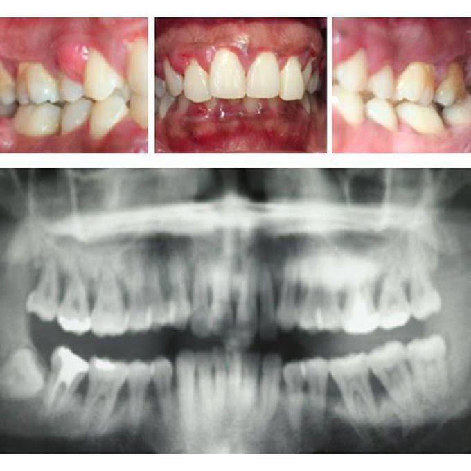 Aggressive periodontitis