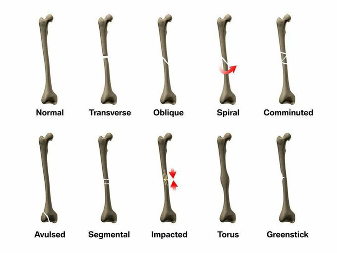 Types of fracture