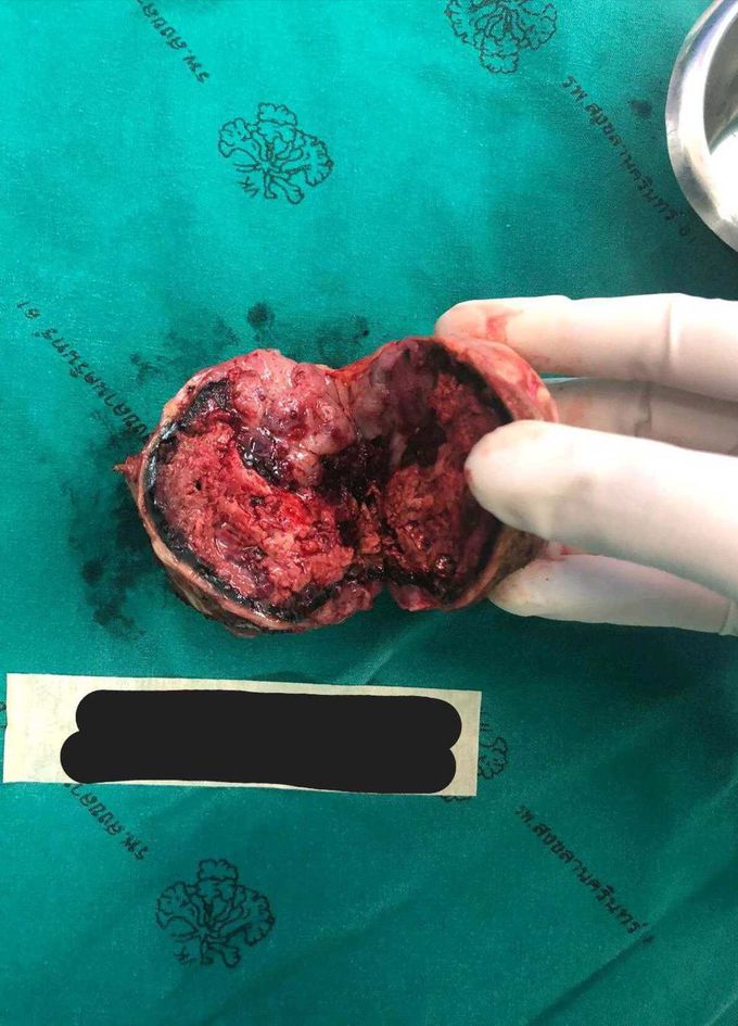 Tumor