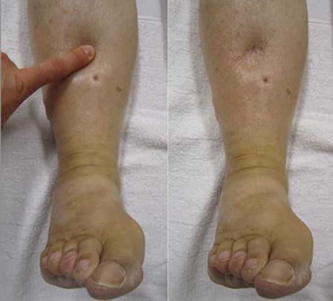 Symptoms of Anasarca