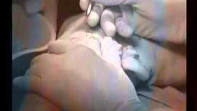 varicose vein surgery