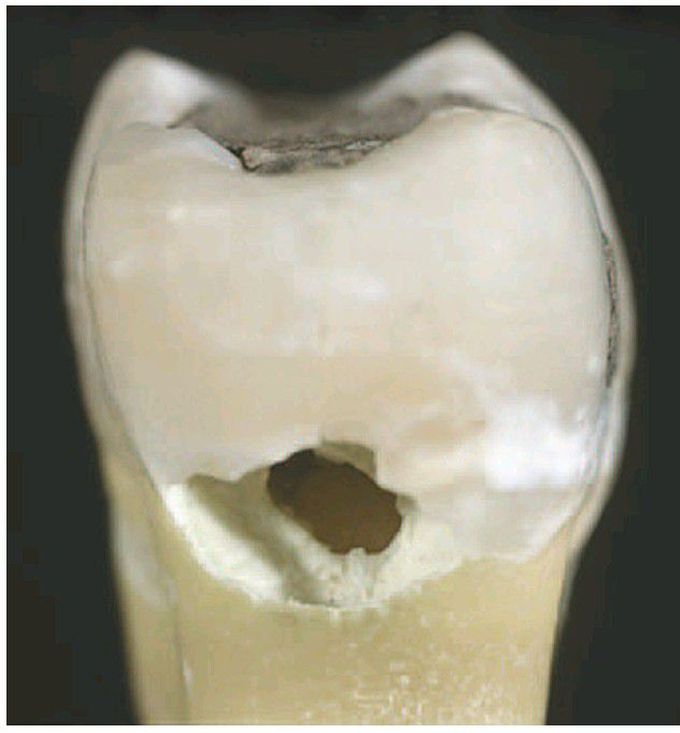 Idiopathic external resorption