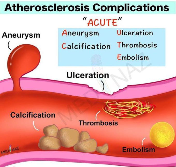 Atherosclerosis Complications Medizzy 