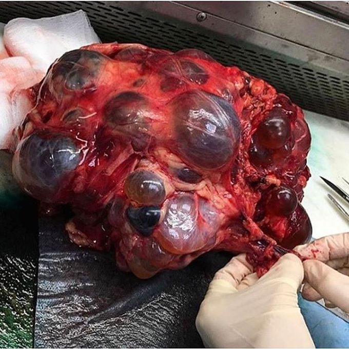Nephrectomy (kidney removal) done for a polycystic kidney that weighted 4.5kg!
