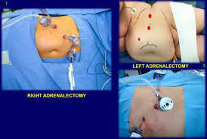 Adrenalectomy