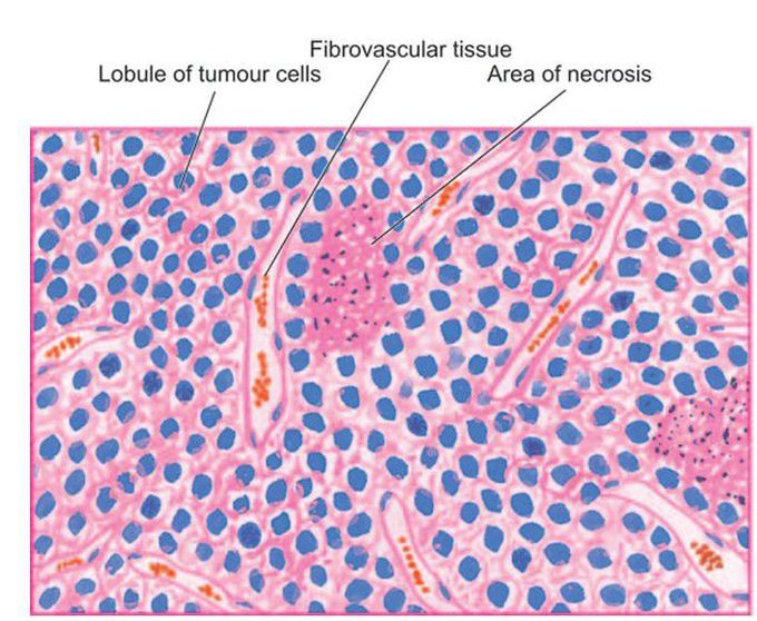 Ewing’s sarcoma.