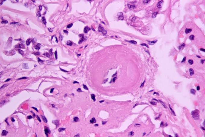 Hyaline arteriosclerosis