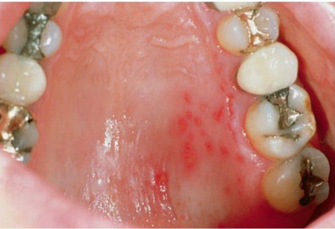 Herpes zoster infection of palate