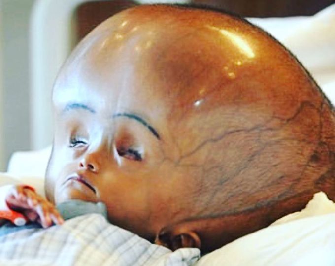 This is a three year old child with severe form of hydrocephalus! 