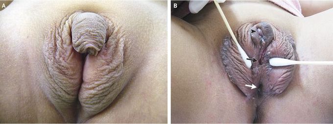 Congenital Adrenal Hyperplasia