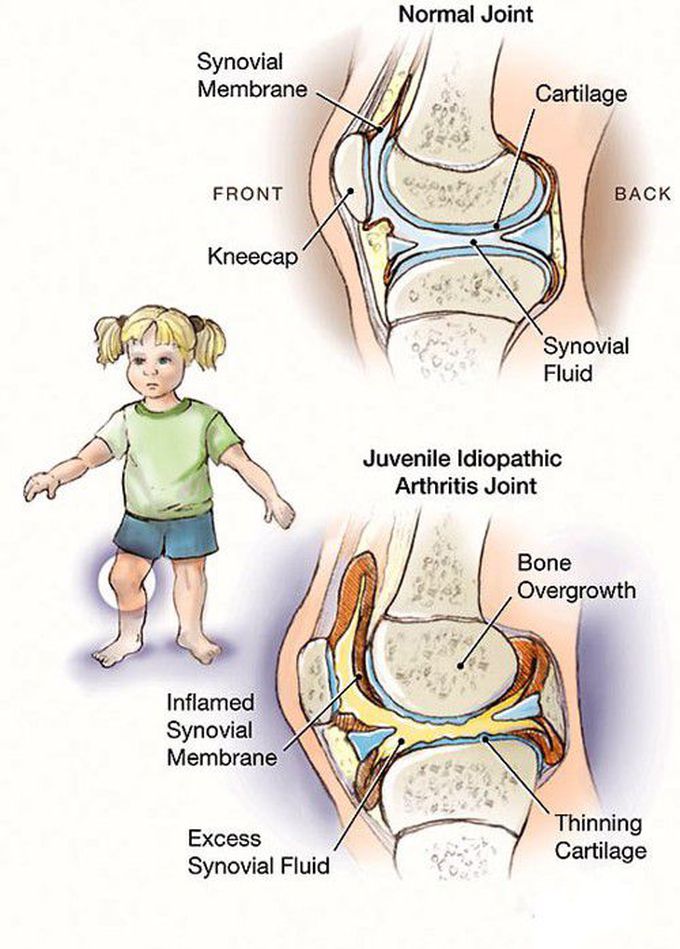 Juvenile idiopathic arthritis - MEDizzy