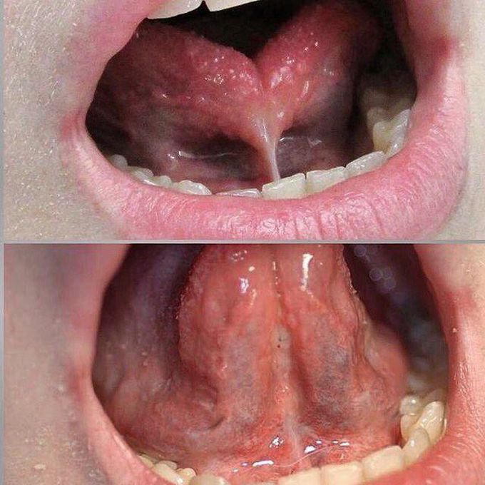 Ankyloglossia