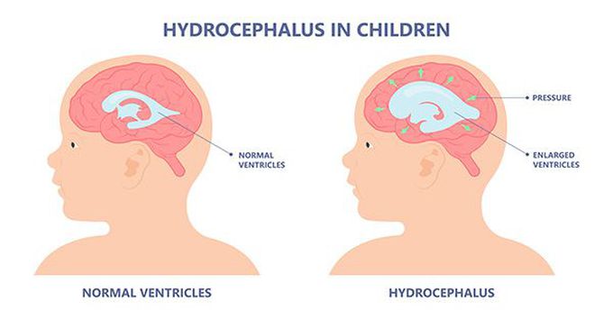 How is hydrocephalus diagnosed