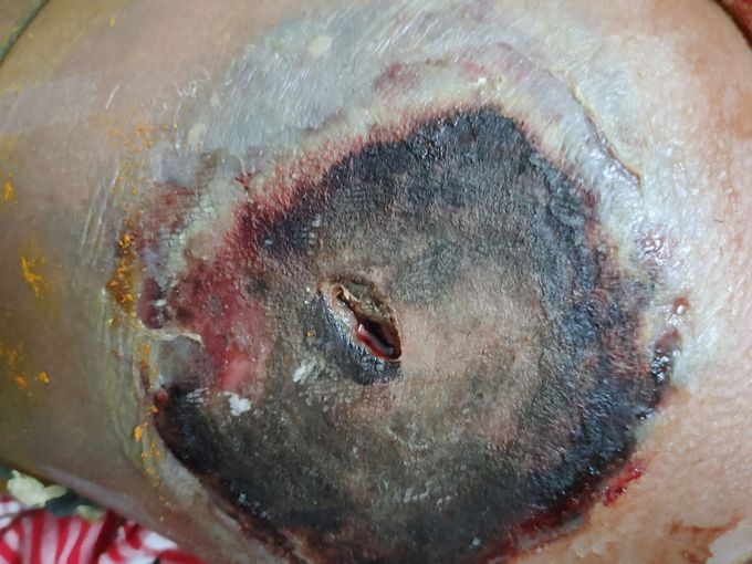 Large mass of carbuncle in buttock region. Whats the treatment you guess🤔🤔😌