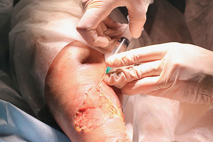 Cell therapy for chronic wounds and venous trophic ulcers