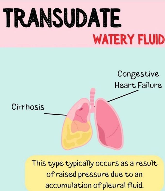 Transudate