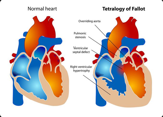 Tetralogy of fallot
