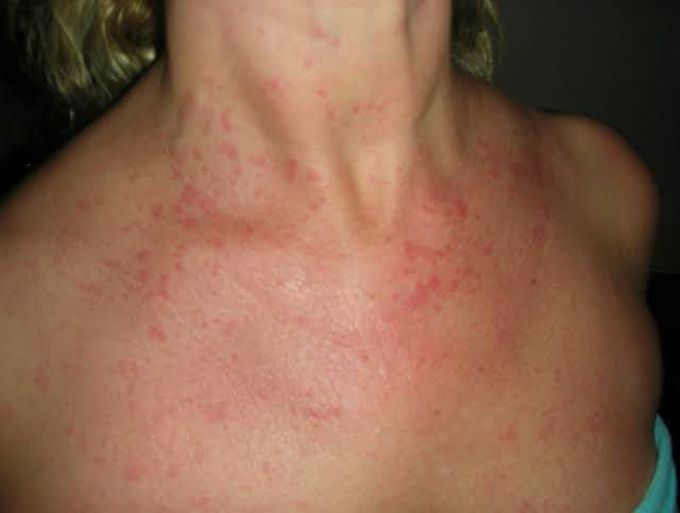 Adult onset Still's disease (AOSD)