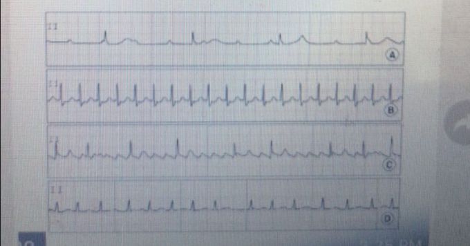 Can someone please help me read these ecgs