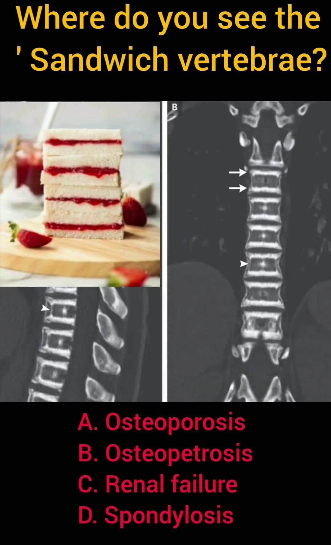 Sandwich Vertebrae MEDizzy