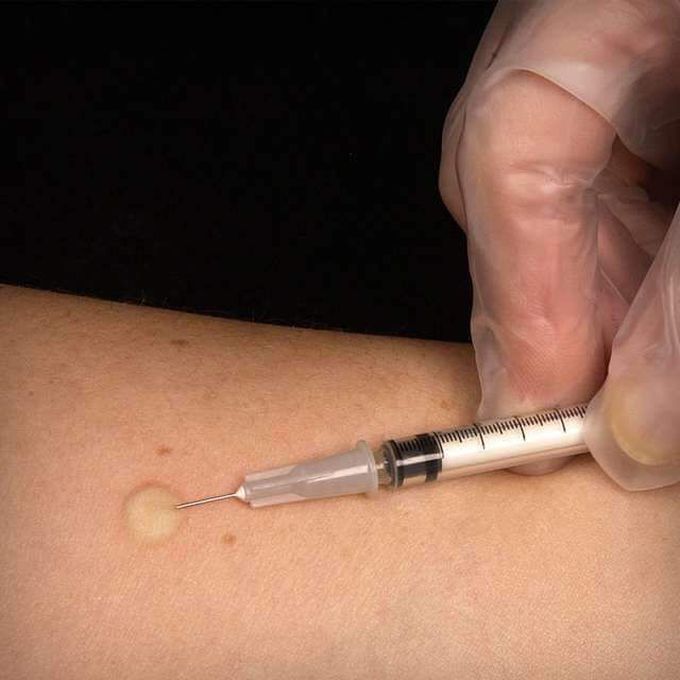 Mantoux test perform for?