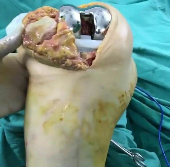 KNEE ARTHROPLASTY