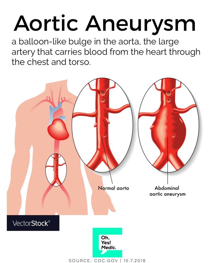 Aortic Aneurysms