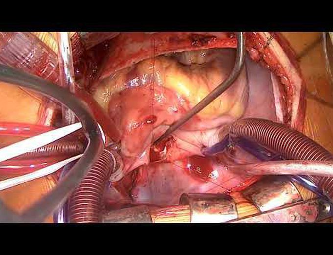Conventional Repair of Supracardiac Total Anomalous Pulmonary Venous Connection