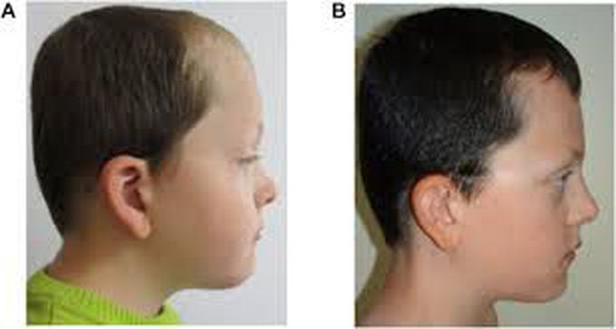 Causes of Noonan syndrome