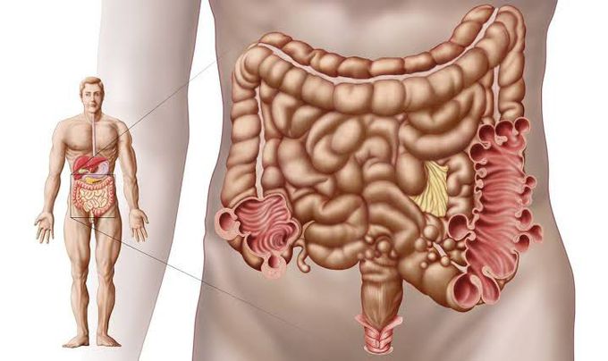 Signs & symptoms of diverticulitis