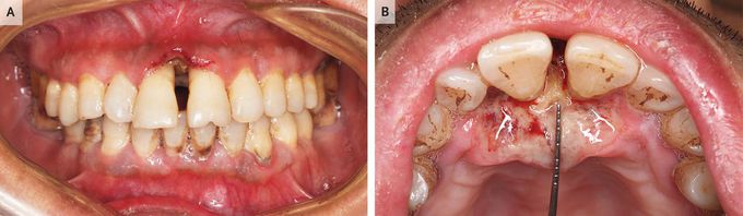 Gingival Ulceration