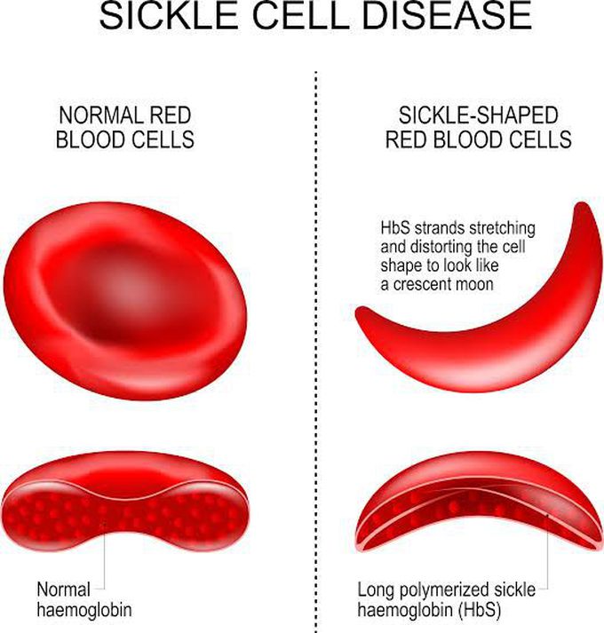 Sickle Cell Disease